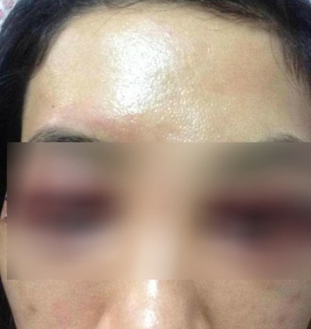 Những ca tai biến kinh hoàng vì làm đẹp ảnh 3